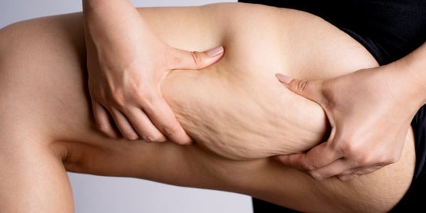 Cellulit – czym jest i jak się go pozbyć?