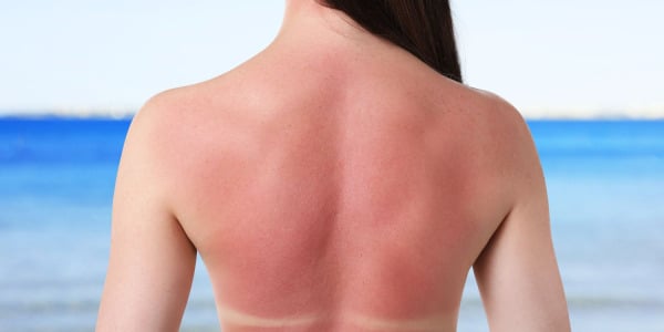 Co na oparzenia słoneczne? Czerwona skóra po opalaniu – jak długo schodzi?
